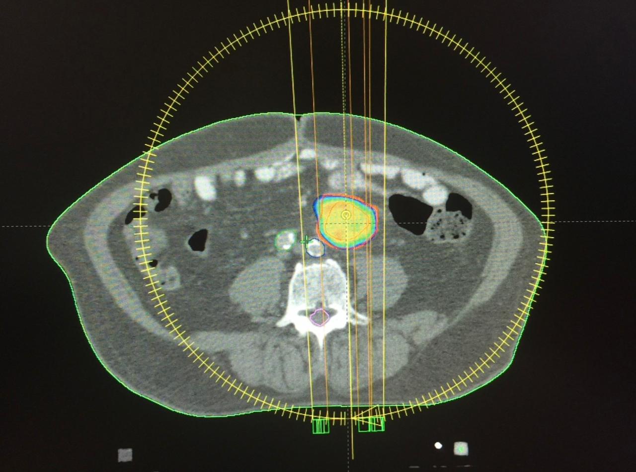Radiocirugía intracraneal