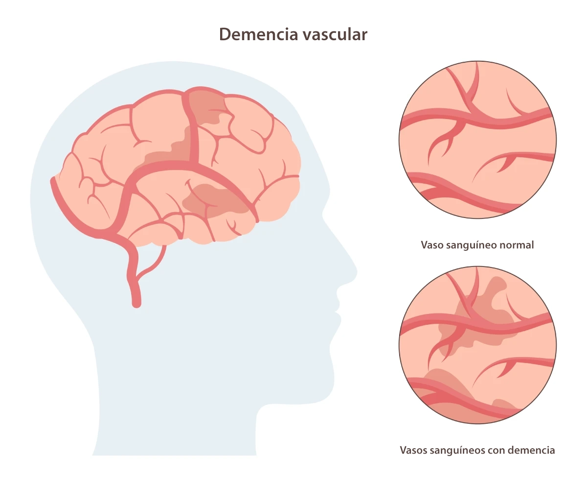 dementia