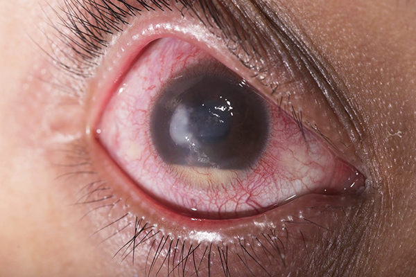 GLAUCOMA